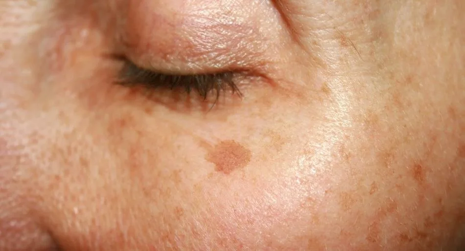 Как питание влияет на старческие пятна: продукты, которые помогут